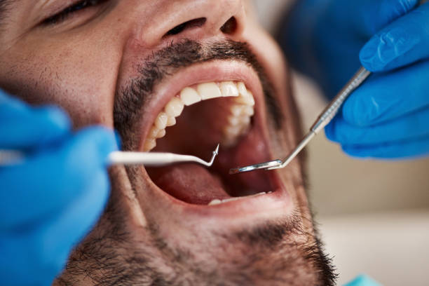 Best Emergency Dental Care for Broken or Chipped Teeth in Wentzville, MO